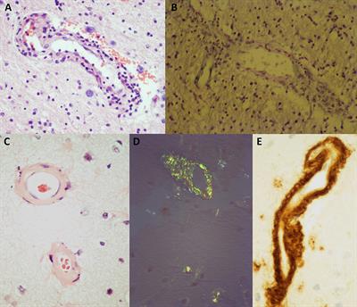 Frequency of deep-seated cerebral microbleeds in patients with lobar hemorrhages and histopathological evidence for cerebral amyloid angiopathy